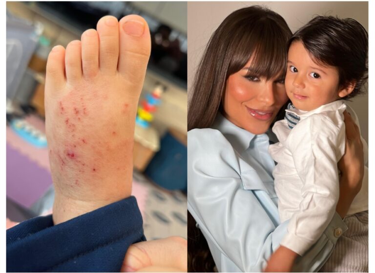 Roupas novas e sarna humana: especialista alerta para cuidados com bebês, depois que o filho de uma famosa foi infectado